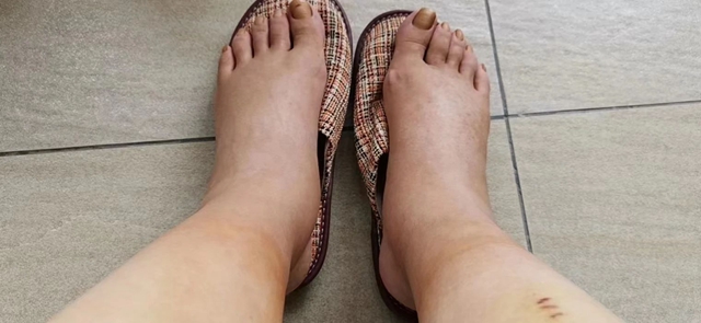 全身一按一个坑，很多人都忽略了这个病……