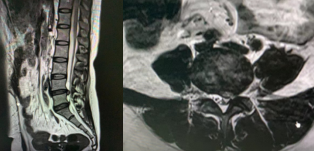 【关注】切口不到1厘米,腰椎间盘突出患者福音!(图2) 微信图片_20231017093043.png