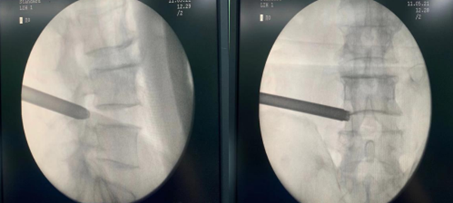 【关注】切口不到1厘米,腰椎间盘突出患者福音!(图3) 微信图片_20231017093047.png