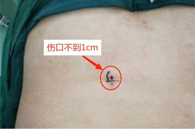 【关注】切口不到1厘米,腰椎间盘突出患者福音!(图7) 微信图片_20231017093104.png