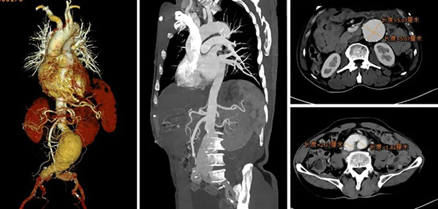 【警惕】肚子里的“不定时炸弹”,要当心……(图2) 2.jpg