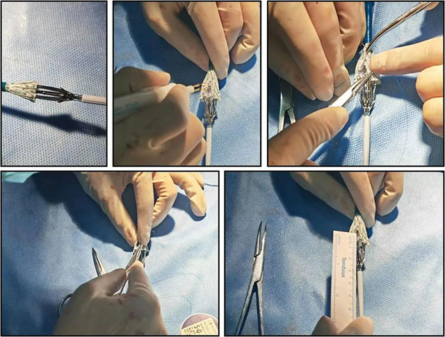 【警惕】肚子里的“不定时炸弹”,要当心……(图3) 3.jpg