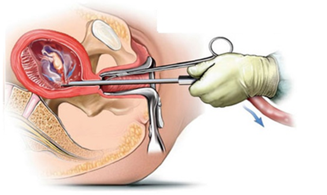 【围观】吃下一粒紧急避孕药后,身体会经历什么?(图4) 微信图片_20231030100830.png