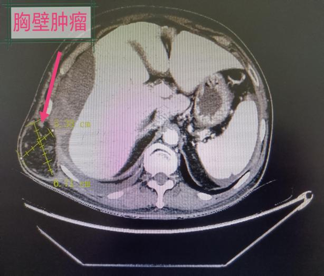 9个科室的专家集体出动，为他取出满满一盆肿瘤...