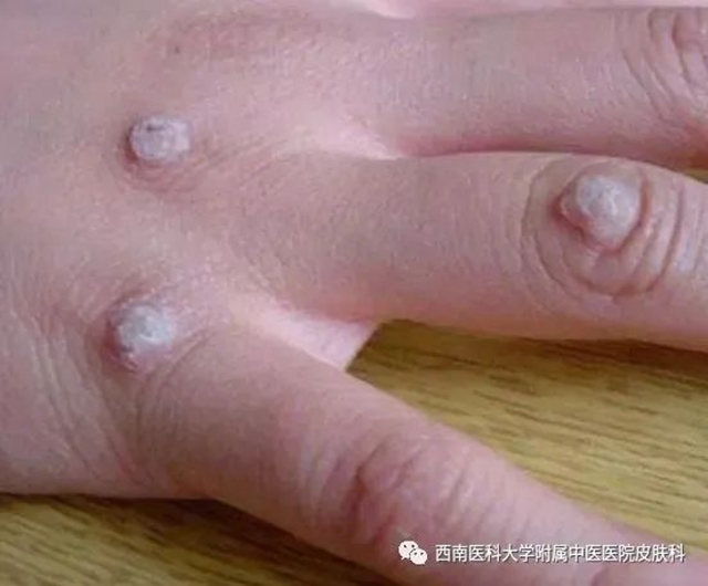【警惕】长这种小疙瘩,当心是病毒感染!(图3) 微信图片_20231212110242.jpg