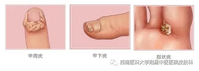 【警惕】长这种小疙瘩,当心是病毒感染!(图4) 微信图片_20231212110246.jpg