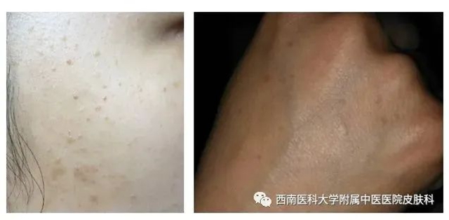 【警惕】长这种小疙瘩,当心是病毒感染!(图5) 微信图片_20231212110251.jpg