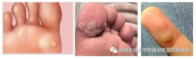 【警惕】长这种小疙瘩,当心是病毒感染!(图6) 微信图片_20231212110256.jpg