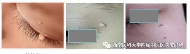 【警惕】长这种小疙瘩,当心是病毒感染!(图7) 微信图片_20231212110301.jpg