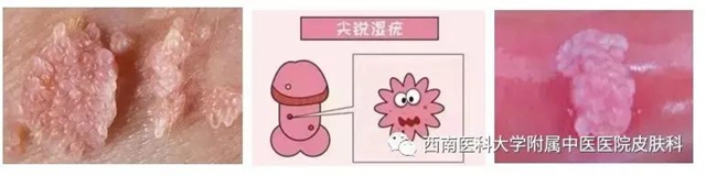 【警惕】长这种小疙瘩,当心是病毒感染!(图8) 微信图片_20231212110306.jpg