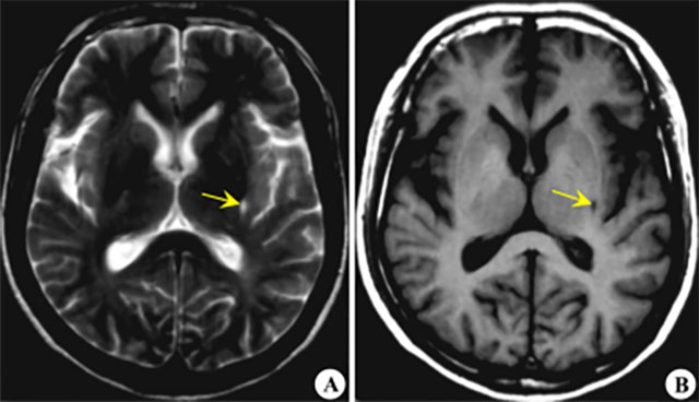 【扩散】医生提醒：米粒大小，就能造成瘫痪！