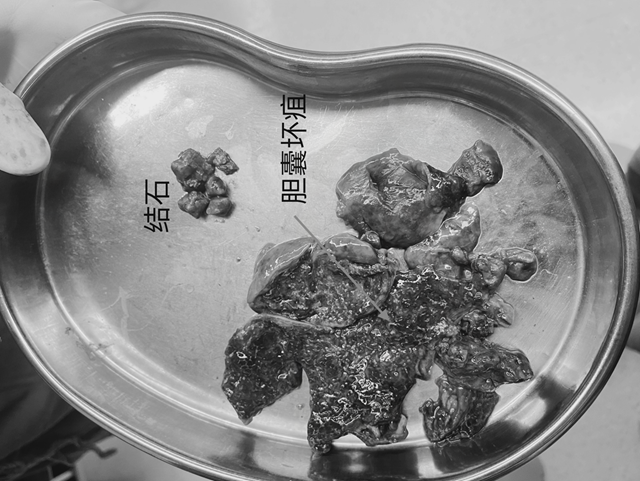 【扩散】一顿牛油火锅，泸州嬢嬢胆囊遭戳脱！