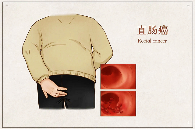 【提醒】错把肠癌当痔疮,耽误了多少性命!大便出现这3个变化,要怀疑肠癌的可能(图3) nEO_IMG_3.jpg