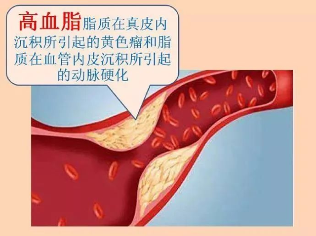 【扩散】不想得脑梗,饭后这3件事少做!(图2) 微信图片_20240116090404.png