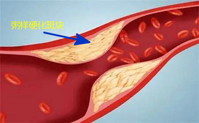 【扩散】不想得脑梗,饭后这3件事少做!(图4) 微信图片_20240116090413.png