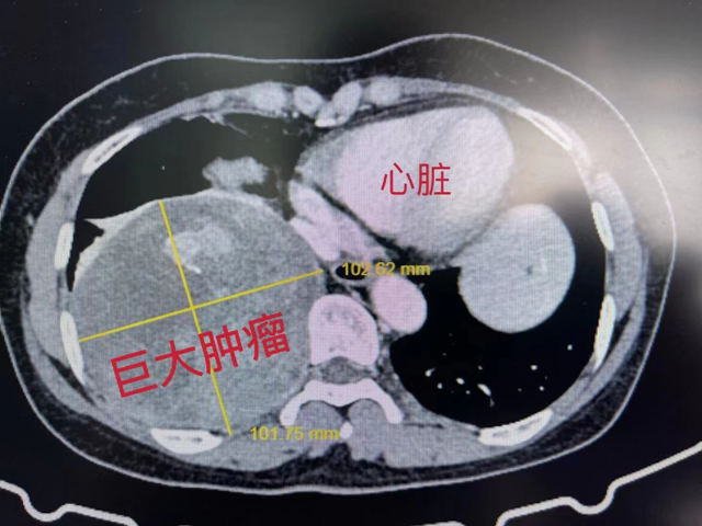 【围观】直径超13厘米，女子长出巨大肿瘤！