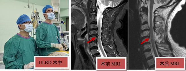 仅开直径不足1厘米小孔做手术，就解决了75岁婆婆常年手臂疼痛困扰……