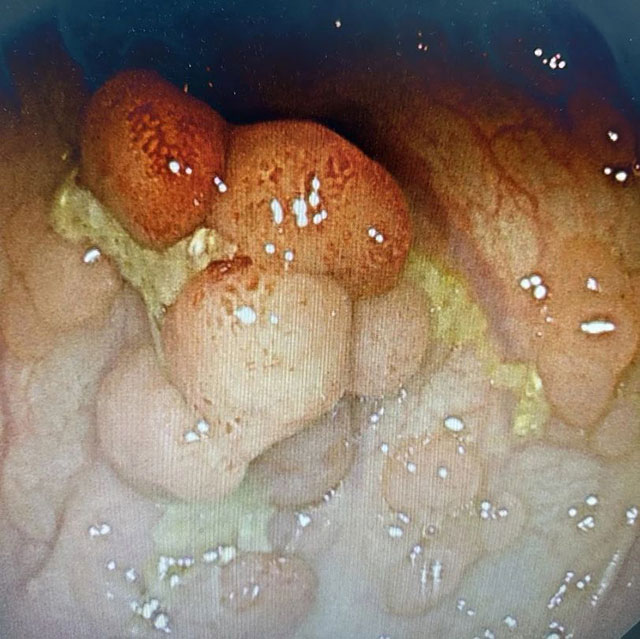 【慎入】密密麻麻的息肉,男子的大肠都被堵满了(图2) 2.jpg