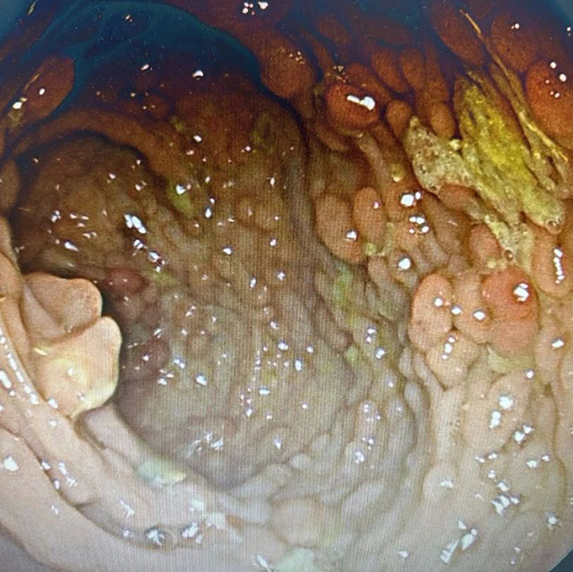 【慎入】密密麻麻的息肉,男子的大肠都被堵满了(图1) 1.jpg