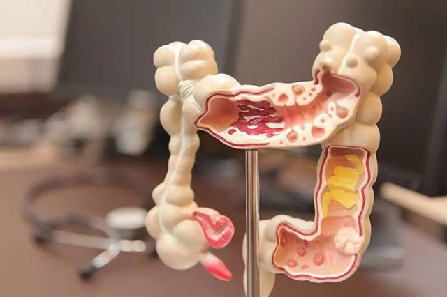 【慎入】密密麻麻的息肉,男子的大肠都被堵满了(图6) 6.jpg