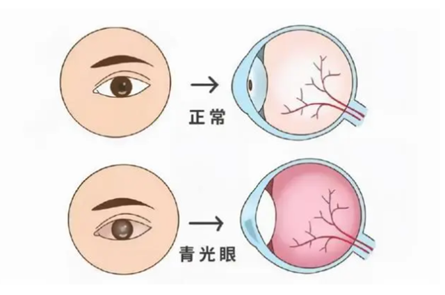 【开会啦】眼睛酸胀、看不清，小心这种致盲病！(文末学术研讨别错过）