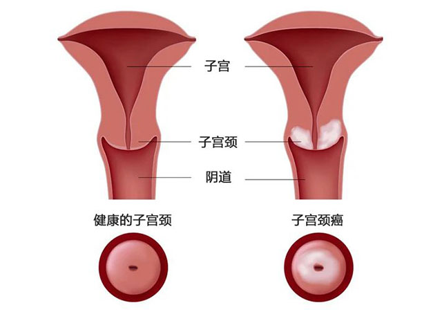 【警惕】24岁女子阴道流液，长菜花状肿块，确诊宫颈癌