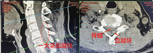 【惊呆】泸州孃孃脖子开大刀……