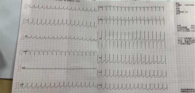 古蔺县中医医院心脑病·肿瘤科运用改良Valsalva动作成功抢救一名阵发性室上性心动过速患者！