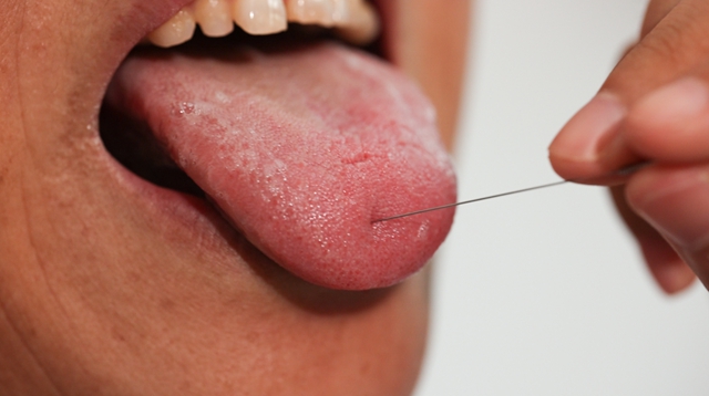 合江县中医医院两项传统医疗技术入选合江非遗名录(图7) 7.jpg