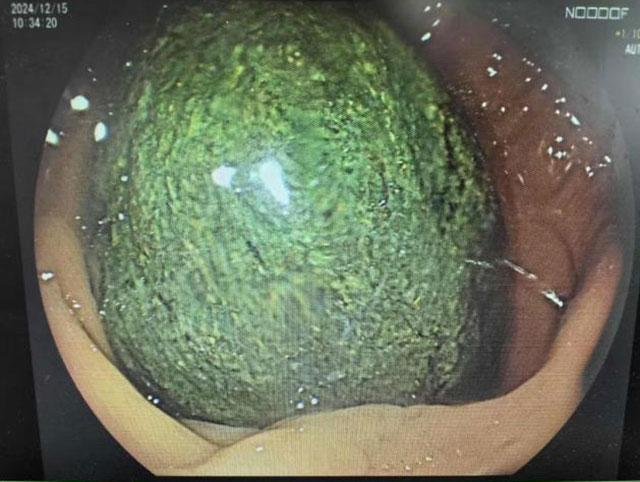 【医患故事】女子胃里取出2个“大石头”!(图3) 3.jpg