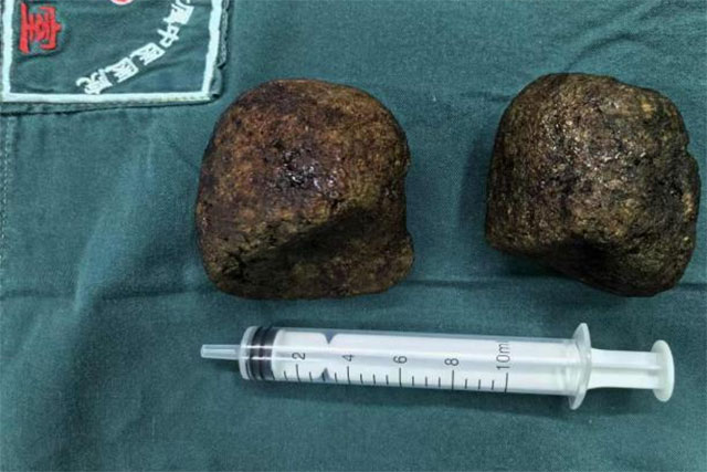 【医患故事】女子胃里取出2个“大石头”!(图4) 4.jpg