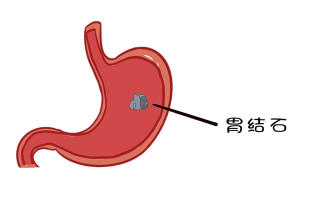 【医患故事】女子胃里取出2个“大石头”!(图6) 6.jpg