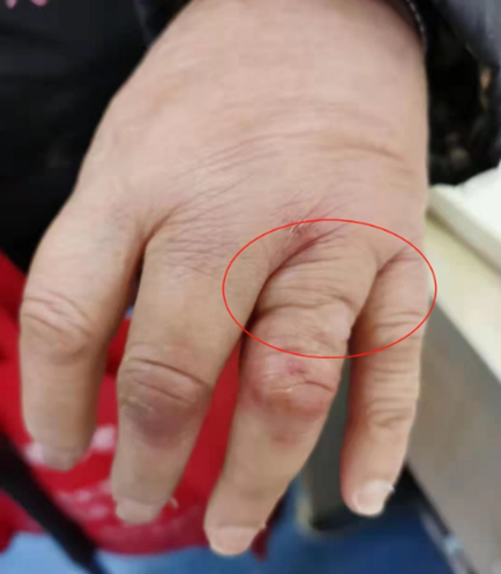 【慎重】容貌走形，手脚“异变”，警惕是这种病！