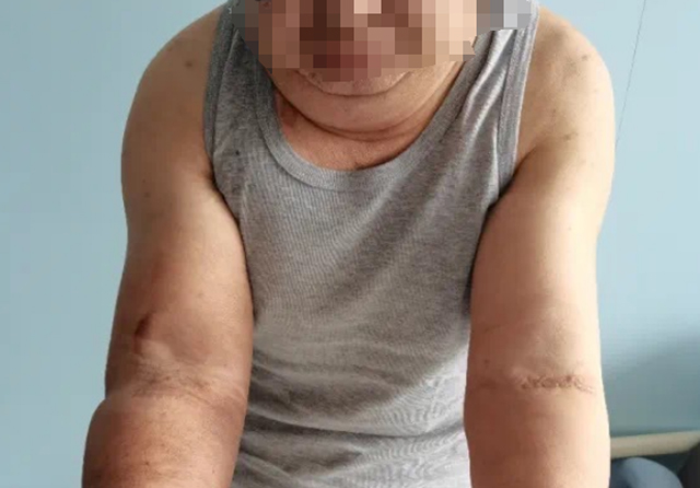 【围观】尿毒症！全身肿胀蔓延、呼吸困难，老王咋个办？