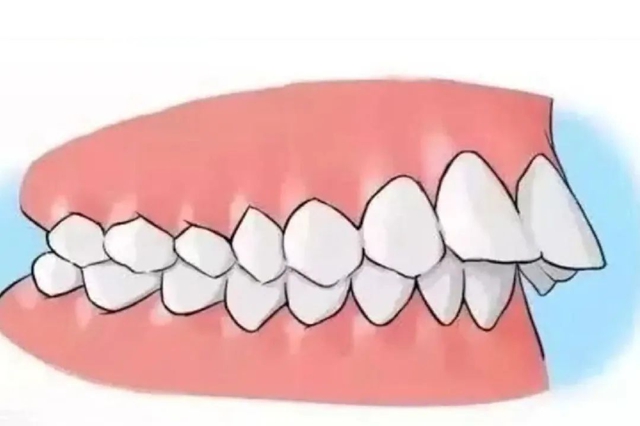 【扩散】“龅牙巴”引热议！咋回事？该咋治？