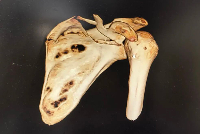 【关注】男子半夜睡觉摔下床，粉碎性骨折！