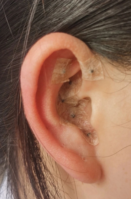 【耳穴埋豆】藏在耳朵上的减肥开关:选对穴位,减肥加倍(图4) 4.jpg