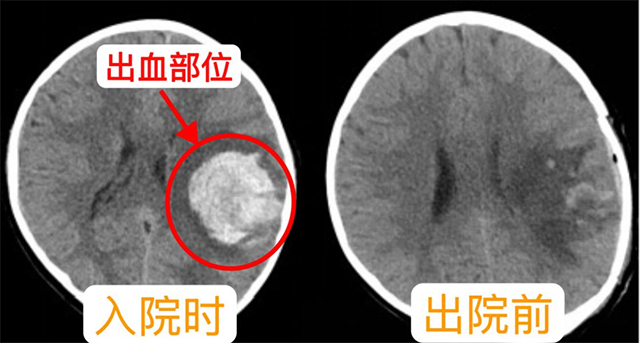 【病例分享】古蔺中医人用仁心妙术点亮九岁患儿的希望之光！