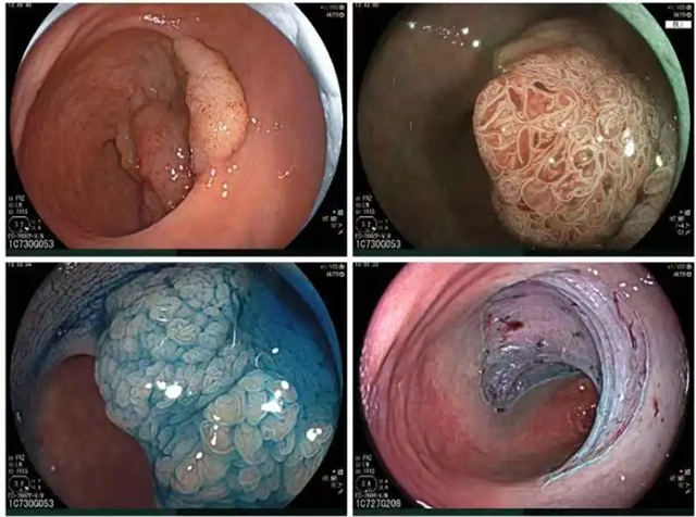 【关注】泸州3个家庭集体患肠癌(图1) 1.jpg