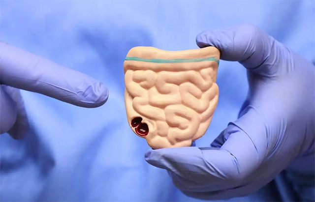 【关注】泸州3个家庭集体患肠癌