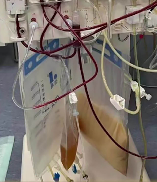 【警惕】男子聚会胡吃海喝后，突发重症入院......