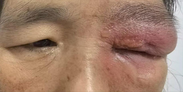 【病例分享】误用草药治疗睑黄瘤险毁容？科学识别与处理指南助您避坑！