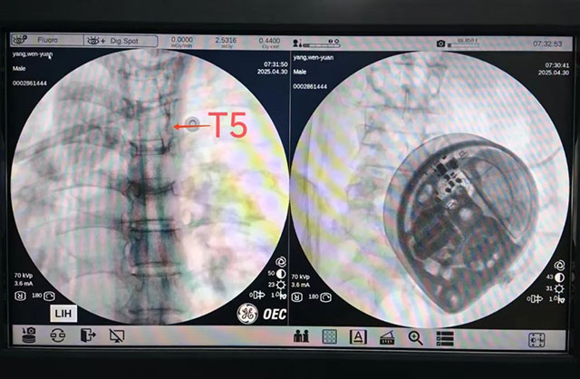 微创植入,长效镇痛!七旬老人告别顽固癌痛重拾生活信心(图2) 2.jpg