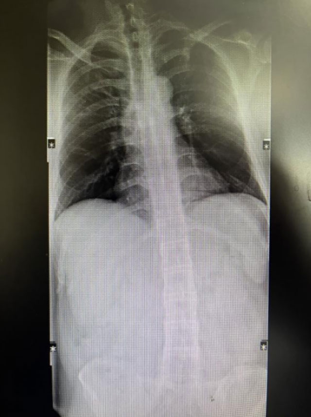 【围观】30岁小伙反复腰背疼痛，竟患“不死癌症”！医生：尚无根治方法