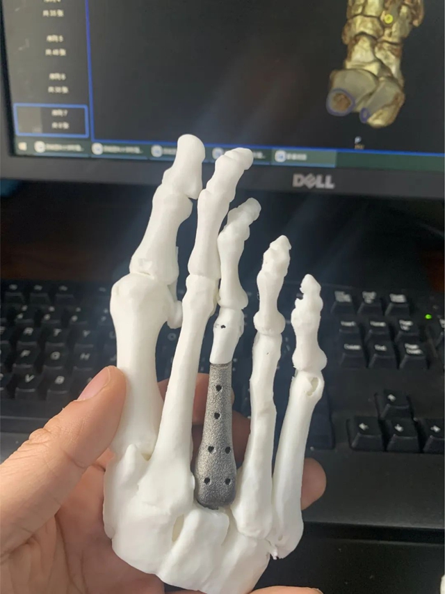 3D打印技术助力跖骨修复,王先生开启自由行走的全新人生!(图2) 6402.jpg