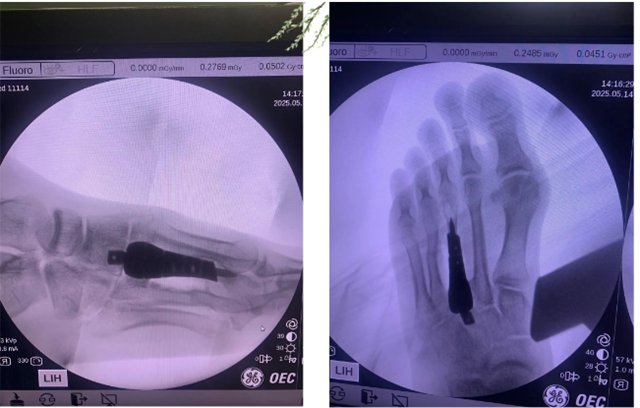 3D打印技术助力跖骨修复,王先生开启自由行走的全新人生!(图3) 9_副本.png