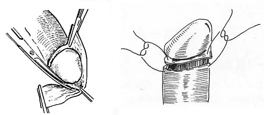 【家有男娃必看】安全、无痛,暑期包皮手术开始预约啦!(图8) 8.png