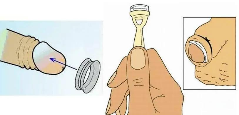 【家有男娃必看】安全、无痛,暑期包皮手术开始预约啦!(图7) 7.png