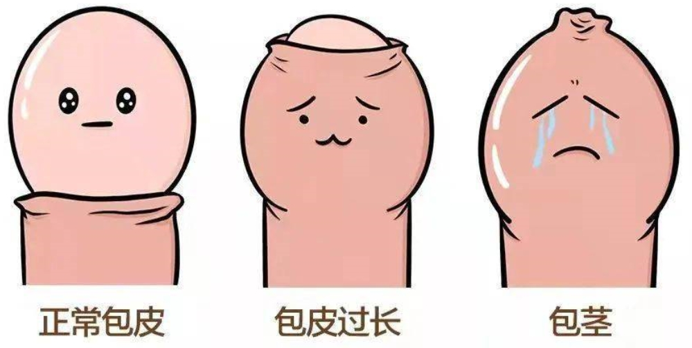 【家有男娃必看】安全、无痛,暑期包皮手术开始预约啦!(图6) 6.png