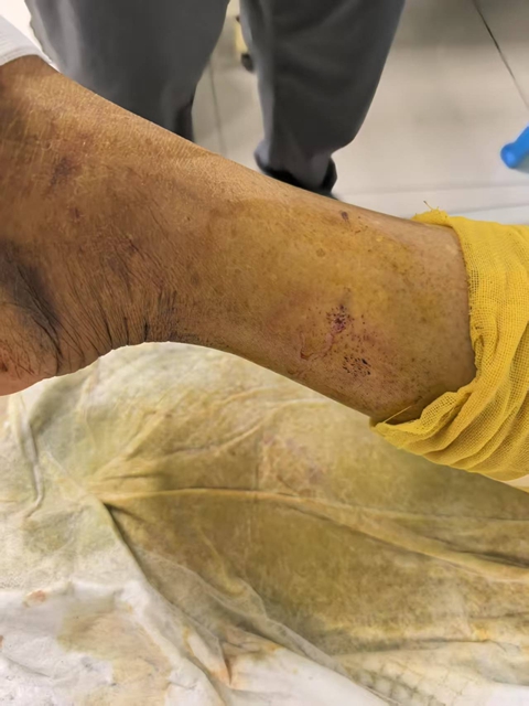 【1000余例蛇咬伤】泸州男子用嘴吸蛇毒,夫妻俩人差点……(图1) 1.jpg